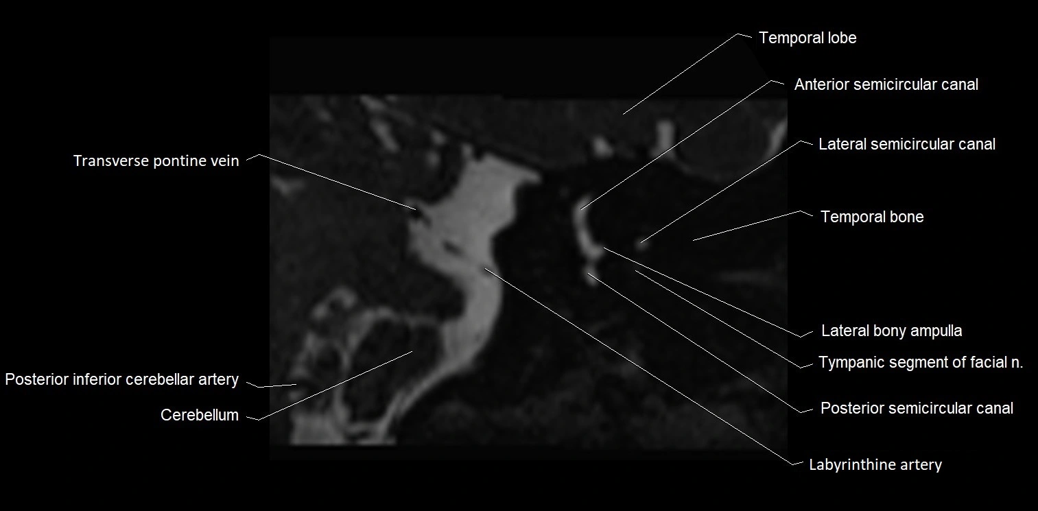 Internal auditory meatus (IAM) axial cross sectional anatomy image 24.webp